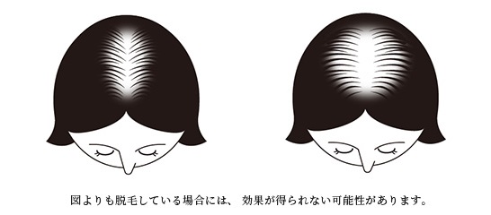 成人女性（20歳以上）で、壮年性脱毛症の方、以下のようなパターンの脱毛あるいは薄毛の方に効果があります。