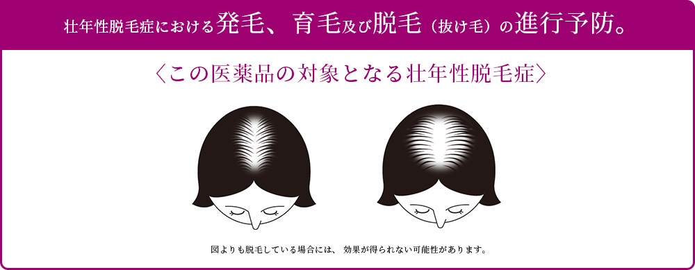 効果効能　壮年性脱毛症における発毛、育毛及び脱毛（抜け毛）の進行予防。