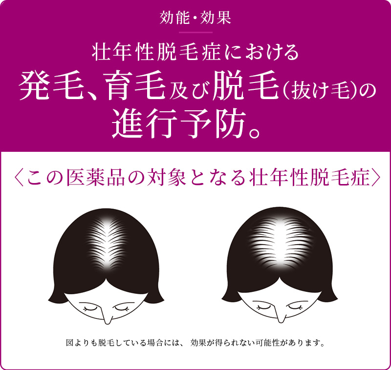 効果効能　壮年性脱毛症における発毛、育毛及び脱毛（抜け毛）の進行予防。